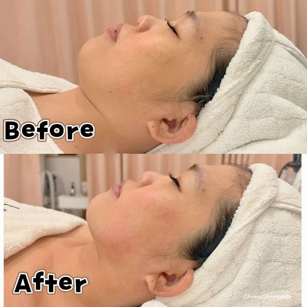 竹北貝拉美學SPA-INDIBA英特波生活美容館|小臉緊緻優惠&加碼|全預約制