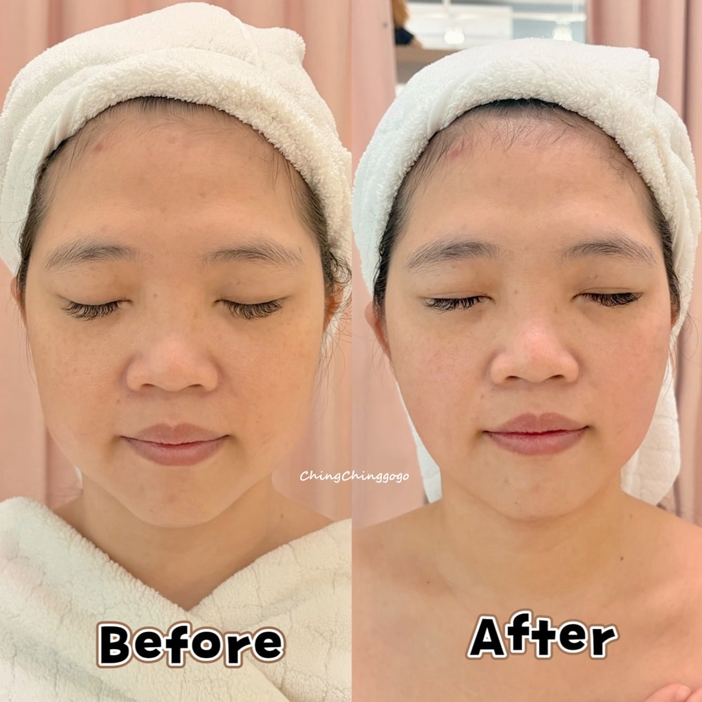 竹北貝拉美學SPA-INDIBA英特波生活美容館|小臉緊緻優惠&加碼|全預約制